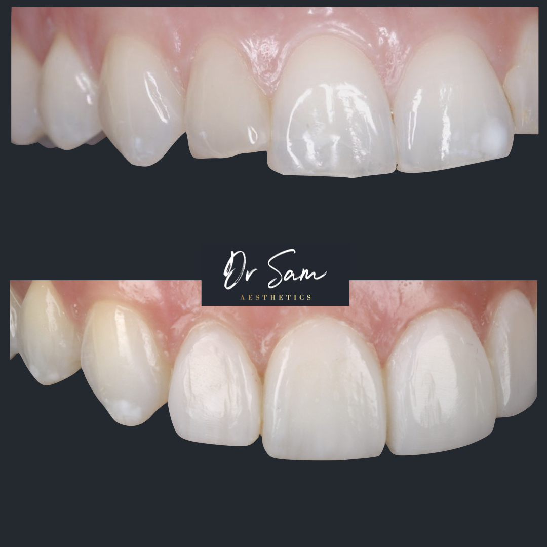 Square before-and-after comparison of freehand composite veneers — the top photo shows upper teeth with an uneven biting edge and a chipped lateral incisor; the bottom photo shows the teeth after treatment, whiter and uniformly shaped, with a central Dr Sam Aesthetics banner