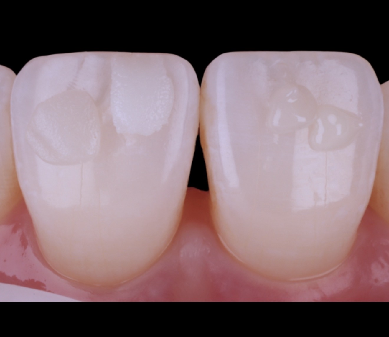 Macro photograph of two central incisor teeth with composite resin applied, demonstrating shade matching and layering