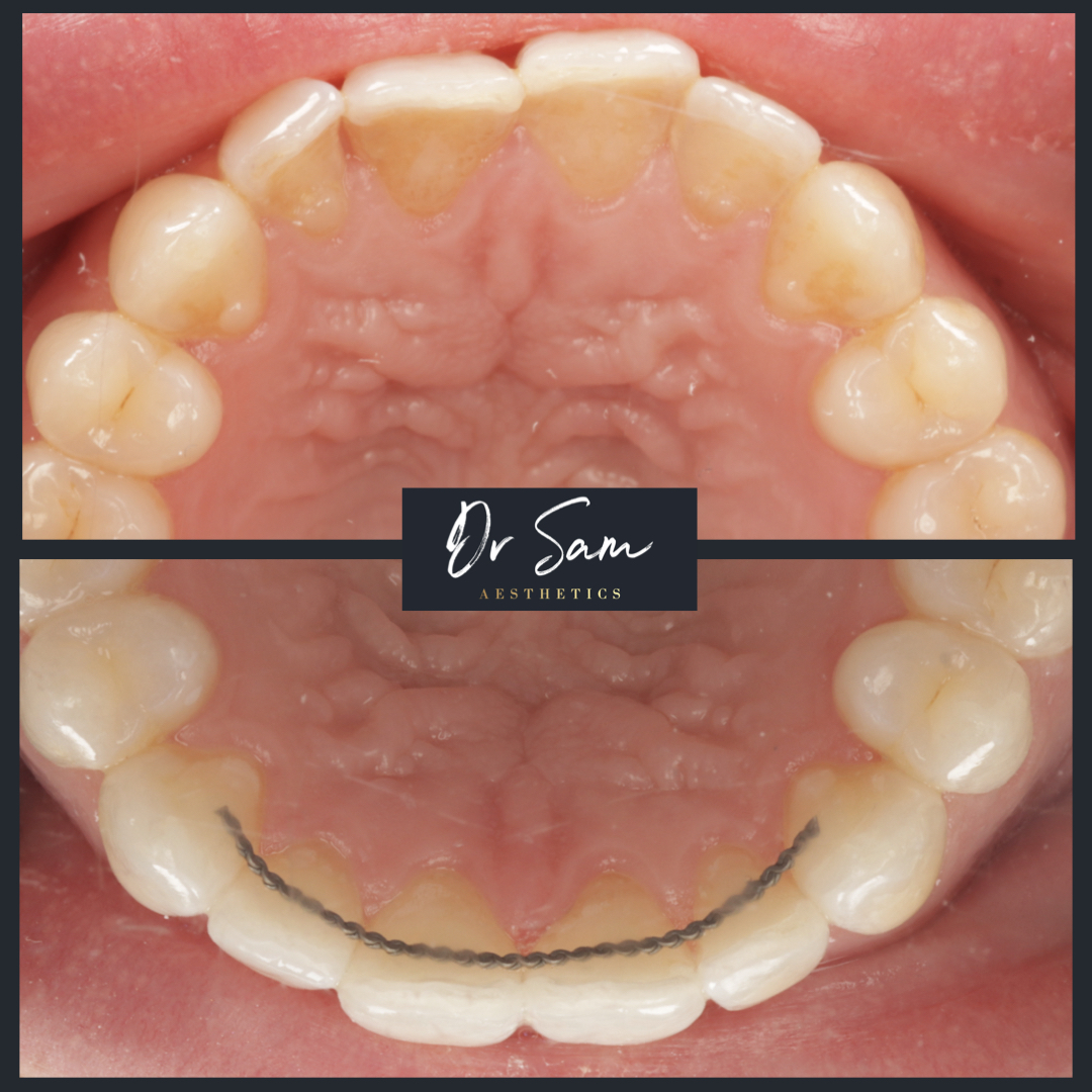 Occlusal before-and-after view of the upper arch showing a fixed lingual retainer wire bonded to the back of the front six teeth, demonstrating placing wires and removing composite buttons