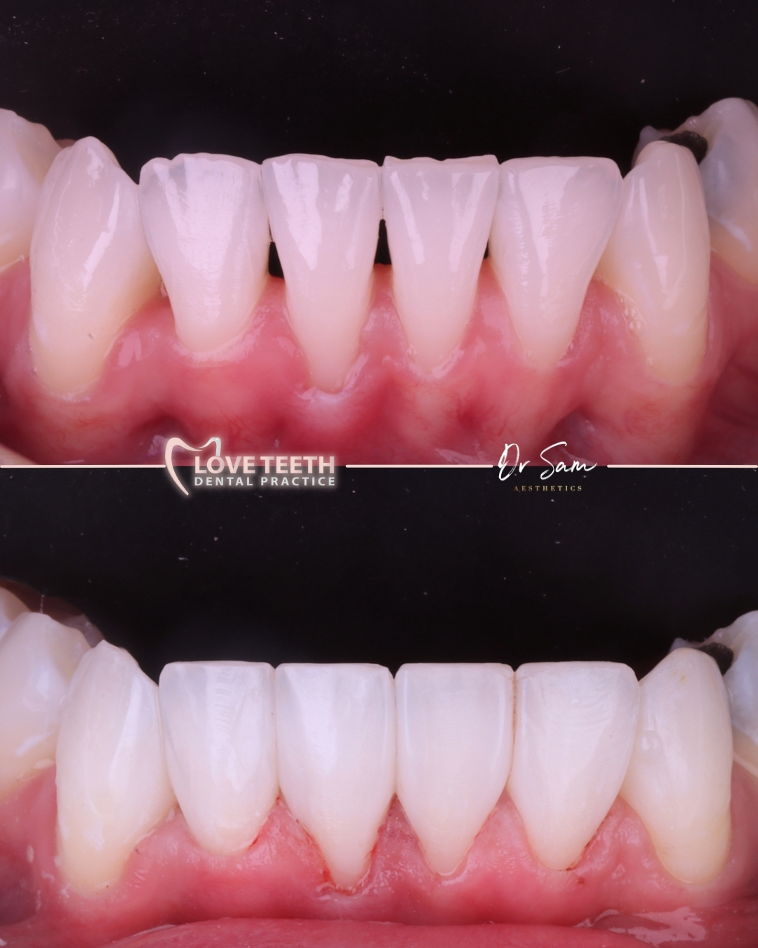 Before and after comparison of anterior composite restorations closing black triangles between lower front teeth