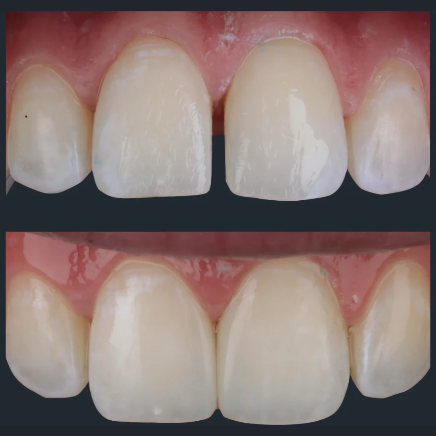 Before and after comparison of diastema closure closing the gap between upper front teeth