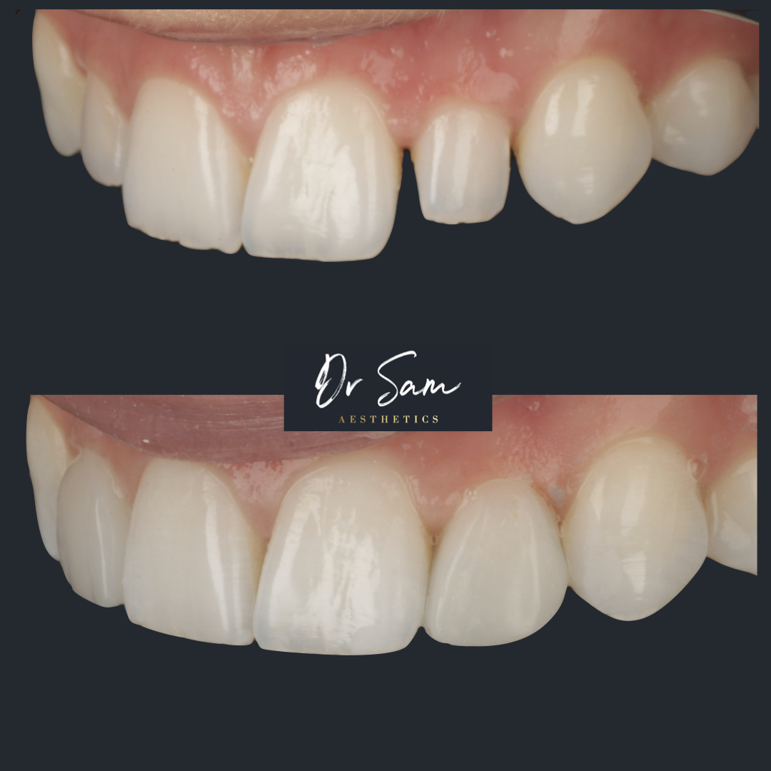 Before and after peg lateral transformation: the top photo shows a small pointed lateral incisor with gaps on either side; the bottom photo shows the restored teeth with the peg lateral corrected to a natural shape and the gaps closed